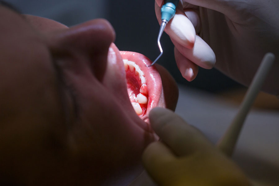 Toothache During Pregnancy How to Avoid Such Pain