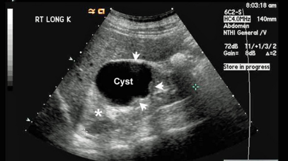 Ultrasound 4 Hydronephrosis EMHUM