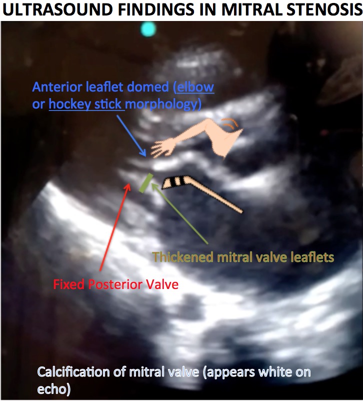 EKG 4 Atrial Enlargement EMHUM