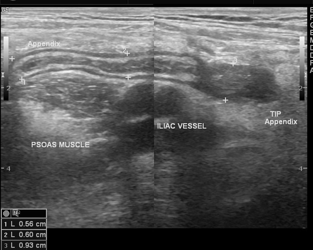 Ultrasound 7 Acute Appendicitis EMHUM