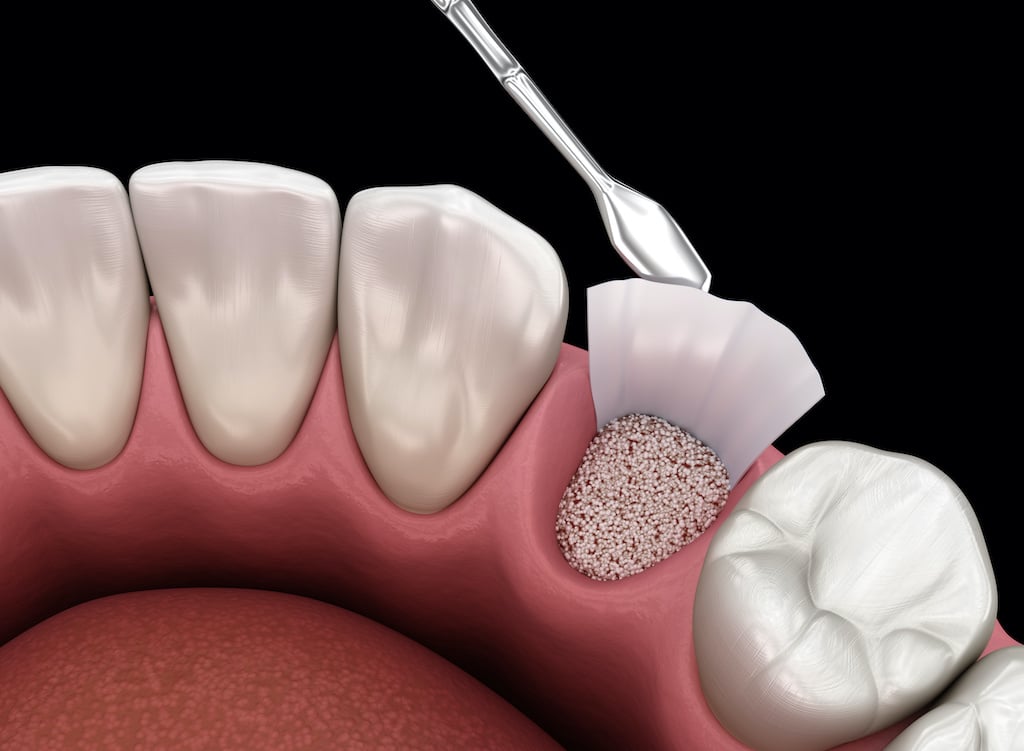 Dental Bone Graft Everything you need to know