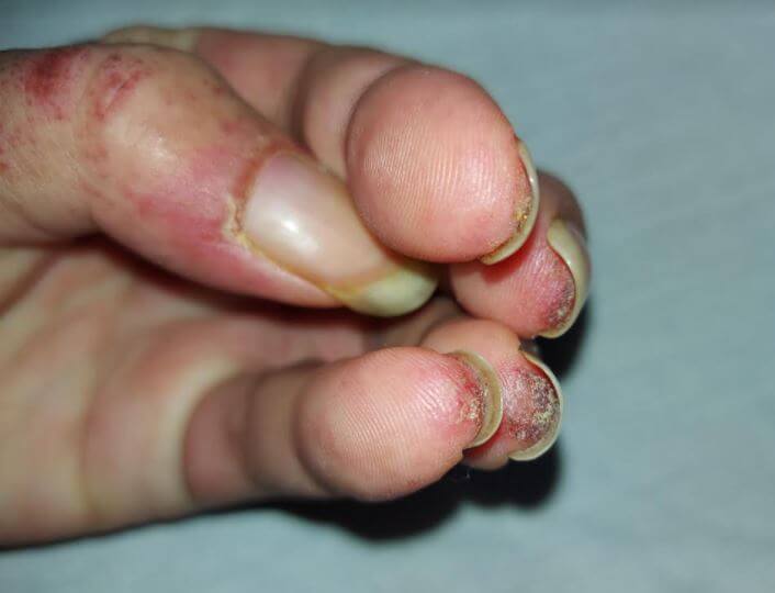 Clinical Challenge Diffuse Rash Affecting Fingertips MPR
