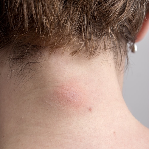 What You Need to Know About Spider Bites Emtec Pest Control