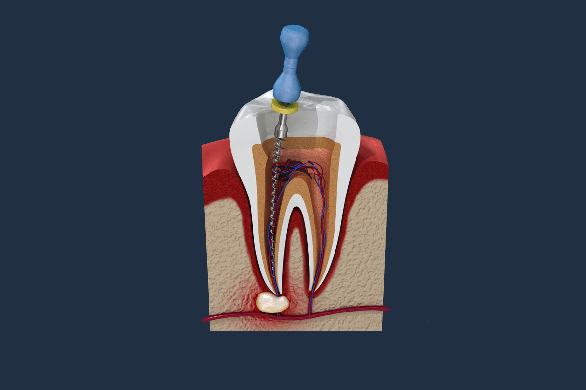 Endodontics Frisco TX, Endodontist