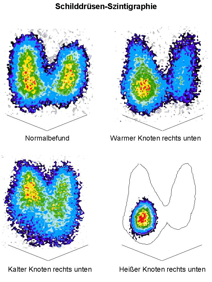 Die schilddrüse produziert das lebensnotwendige hormon thyroxin, welches zahlreiche körperfunktionen beeinflusst. Endokrine Chirurgie