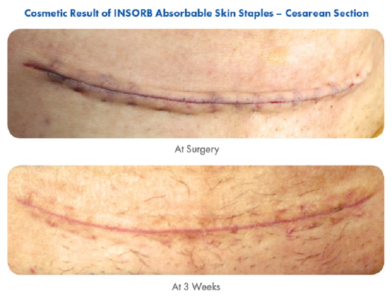 INSORB Absorbable Skin Stapler Endotherapeutics