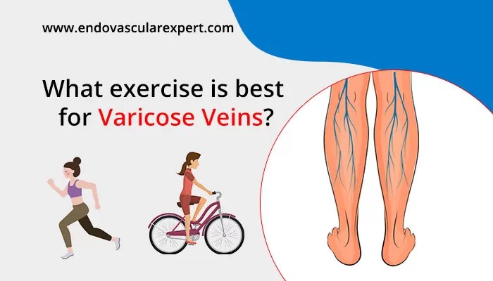 What exercise is best for varicose veins? Endovascular Expert