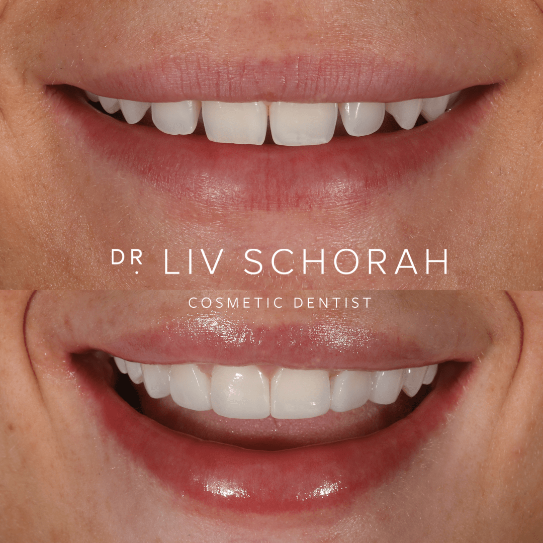 Composite Bonding Leeds Garforth Enhance Dental Enhance Dental