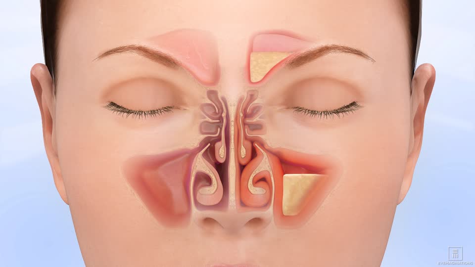 Sinusitis Treatments ENT Associates of San Diego
