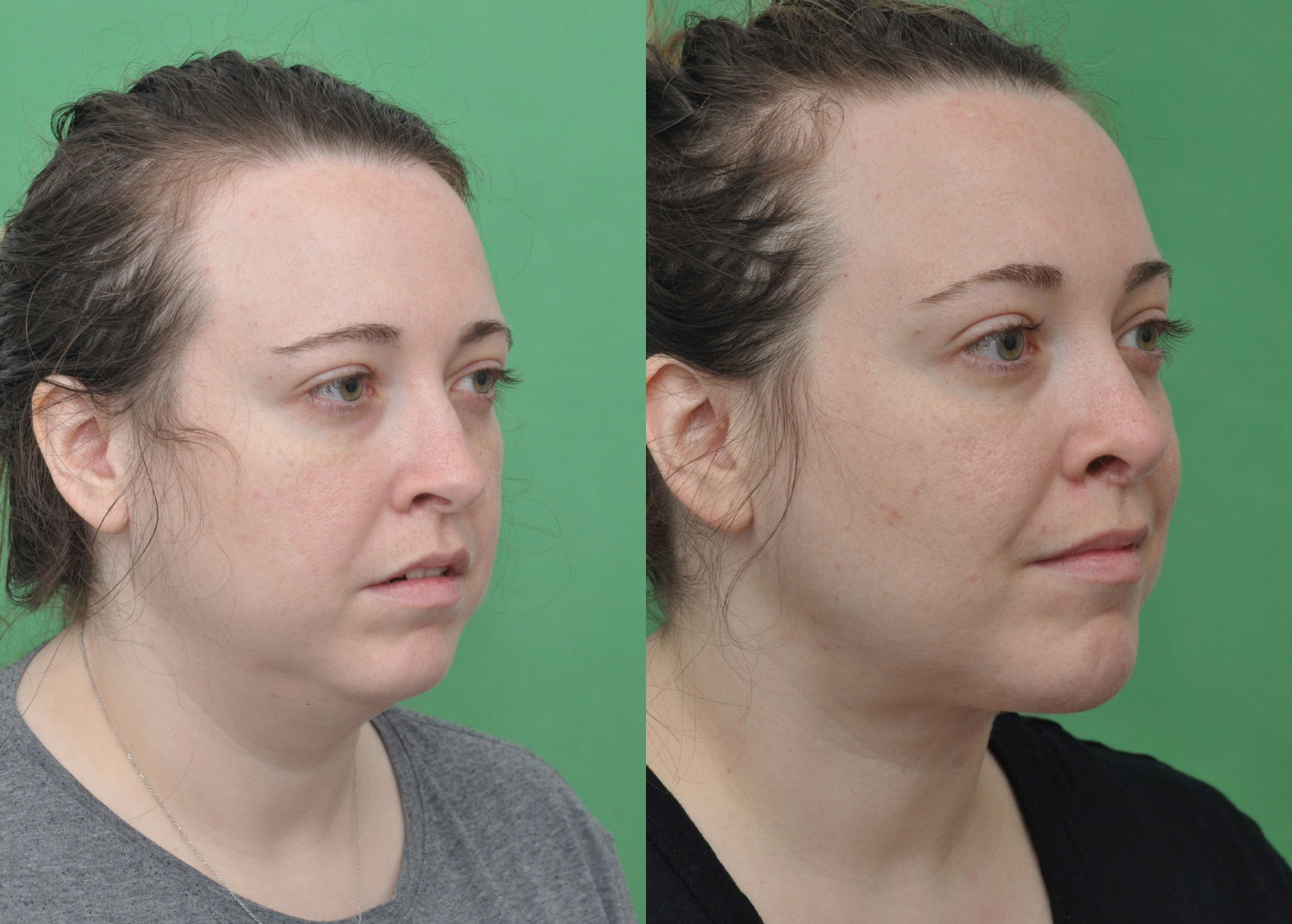 Neck Liposuction Gallery Top Plastic Surgeon In McLean, VA