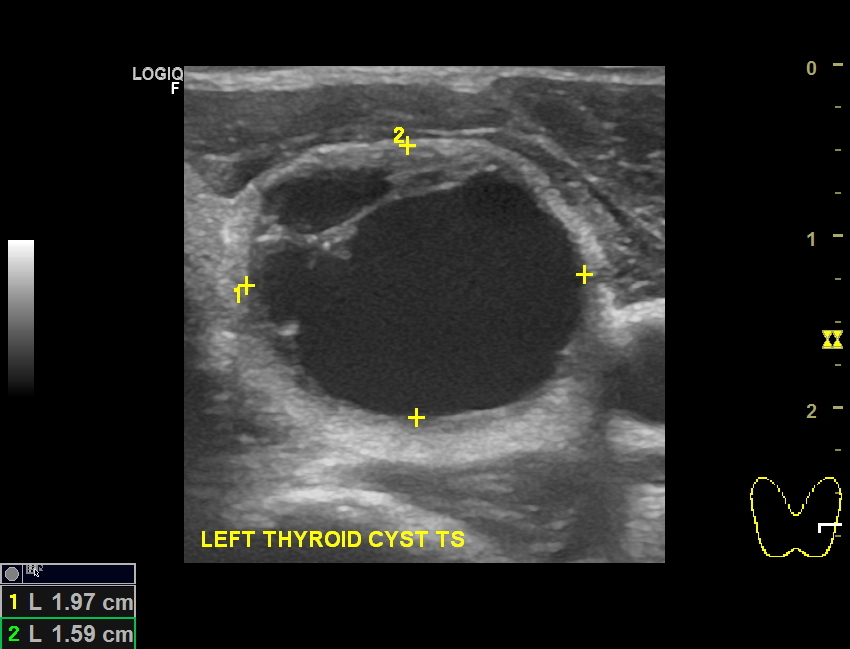 Thyroid cysts Dr Jeeve ENT Specialist