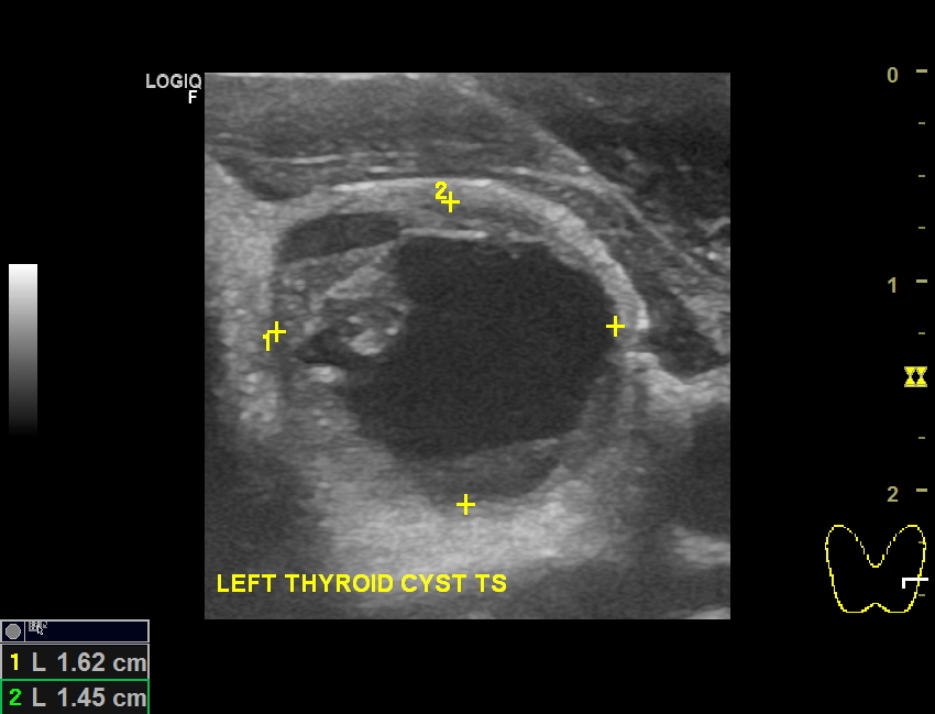 Thyroid cysts Dr Jeeve ENT Specialist