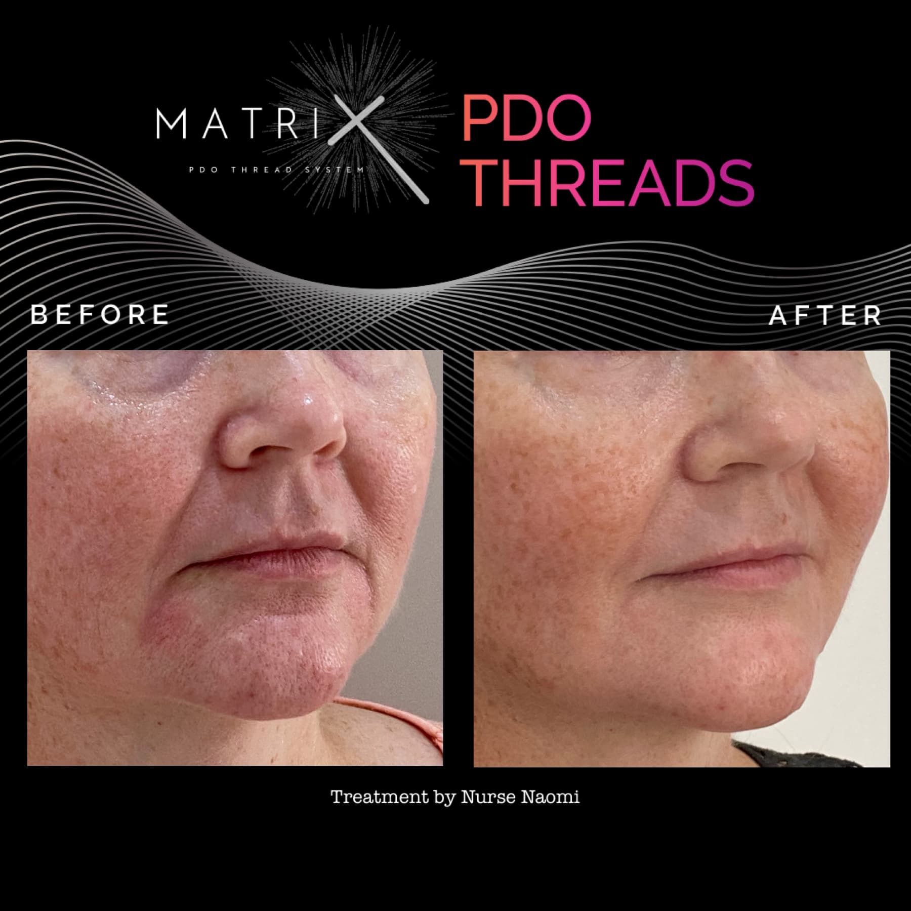 Matrix PDO Mono Threads Your Australian Distributor