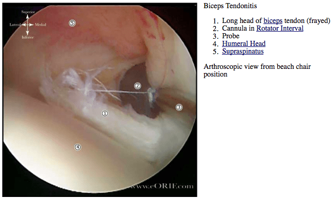 Biceps Tendonitis M75.20 726.12 eORIF