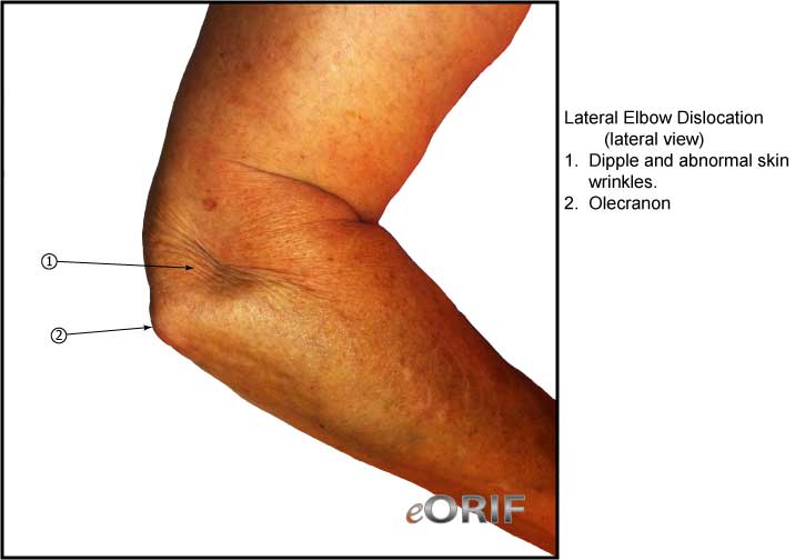 Elbow Dislocation S53.006A 832.00 eORIF
