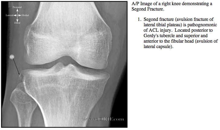 ACL Tear S83.519A 717.83 eORIF