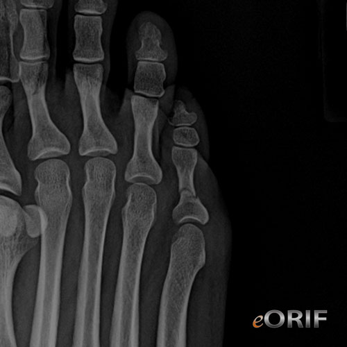Phalanx Fracture S92.403A 826.0 eORIF