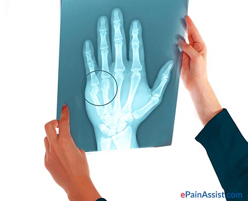 Wrist Joint FractureTypesCausesSymptomsTreatmentMedications, PT
