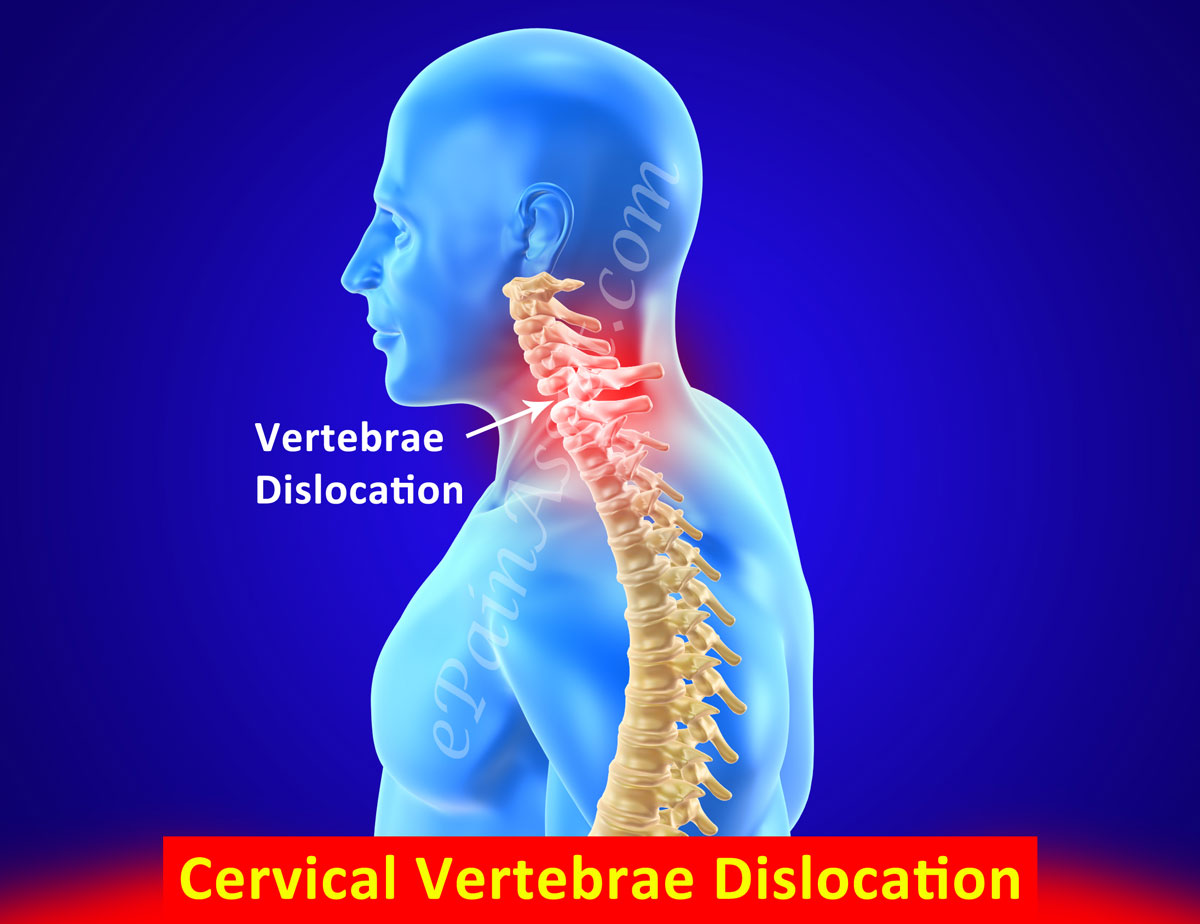 Cervical Vertebrae Dislocation Treatment, Symptoms, Causes