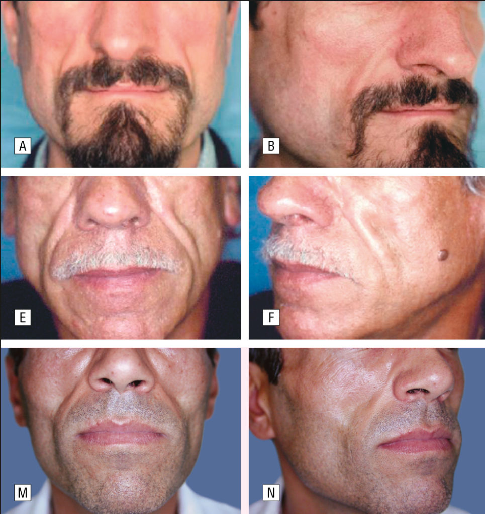 Lipodystrophy & HIV Equality California