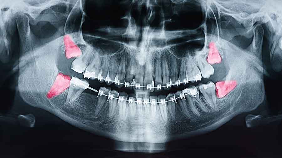 Complications From Not Removing Problem Wisdom Teeth » Lafayette