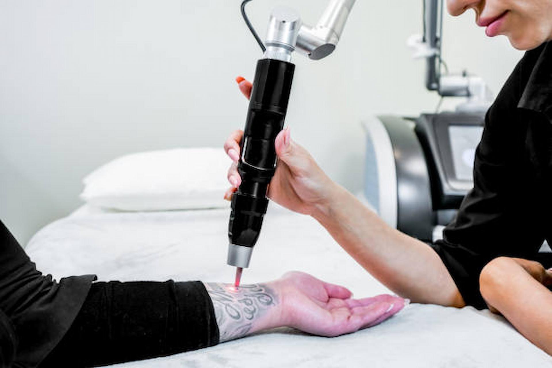 How Often Can You Get Laser Tattoo Removal