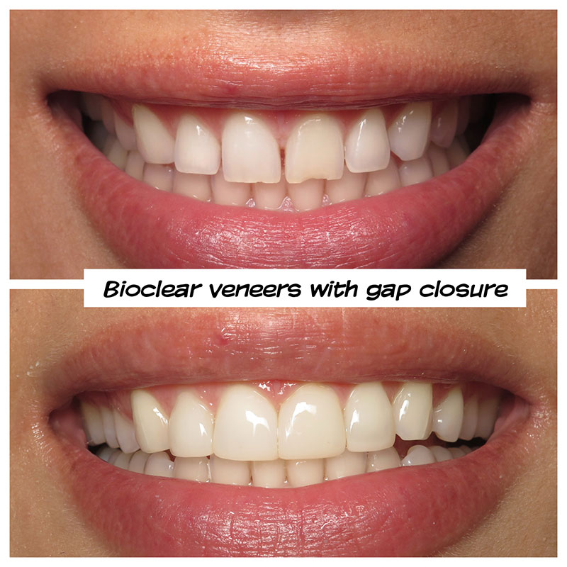 Bioclear veneers with Gap closure David Eshom DDS, Dental Health and