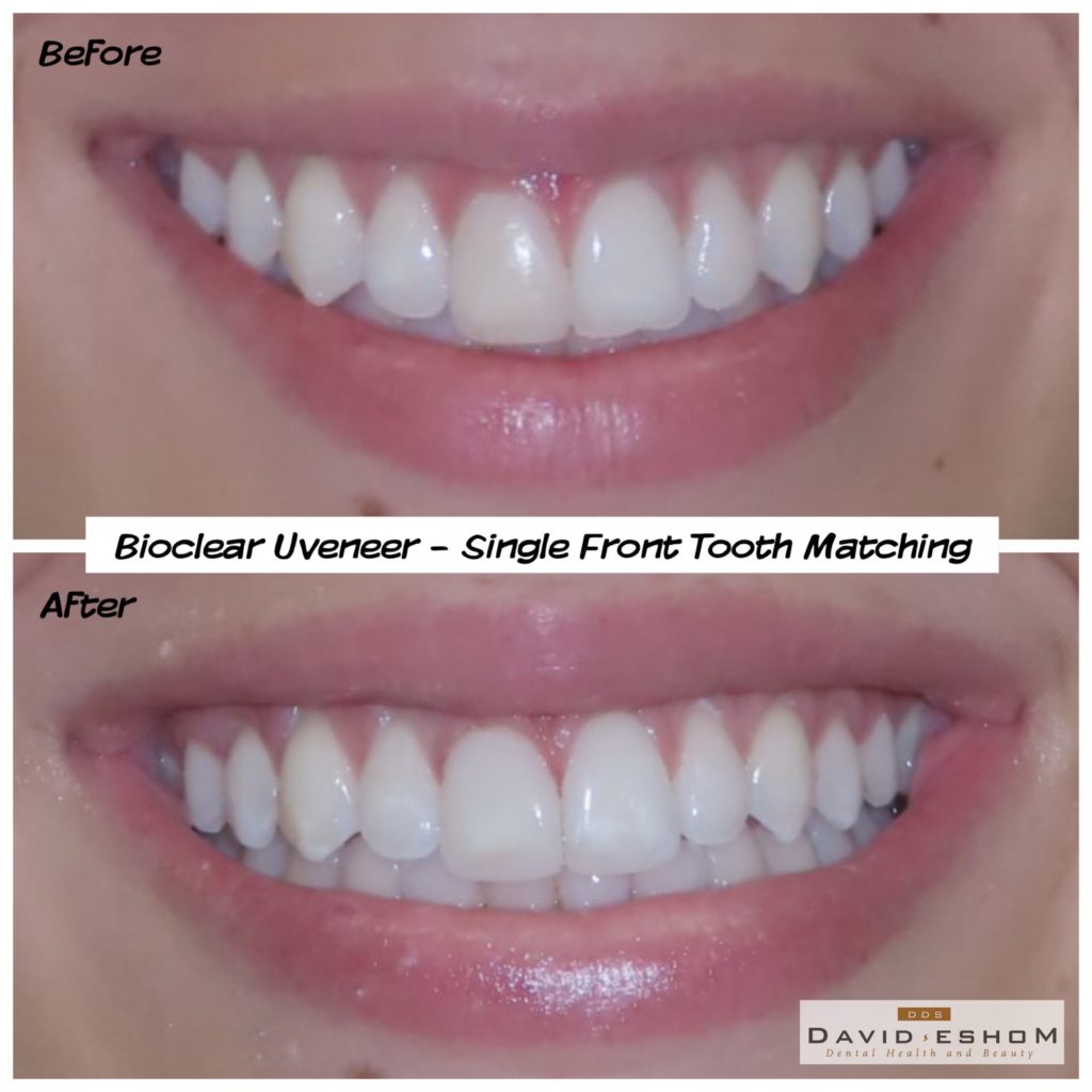 Uveneers Alternative to Porcelain Veneers in San Diego
