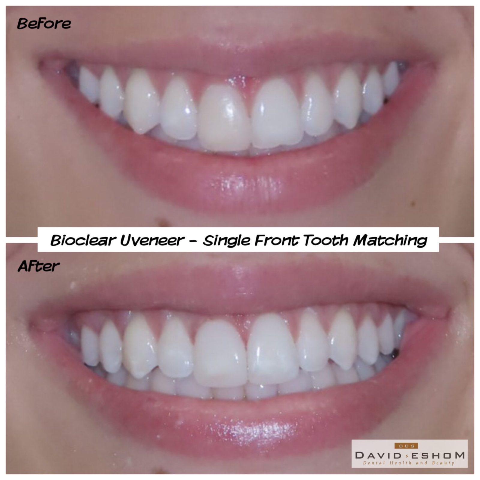 Bioclear Uveneer Single Front Tooth Matching David Eshom DDS