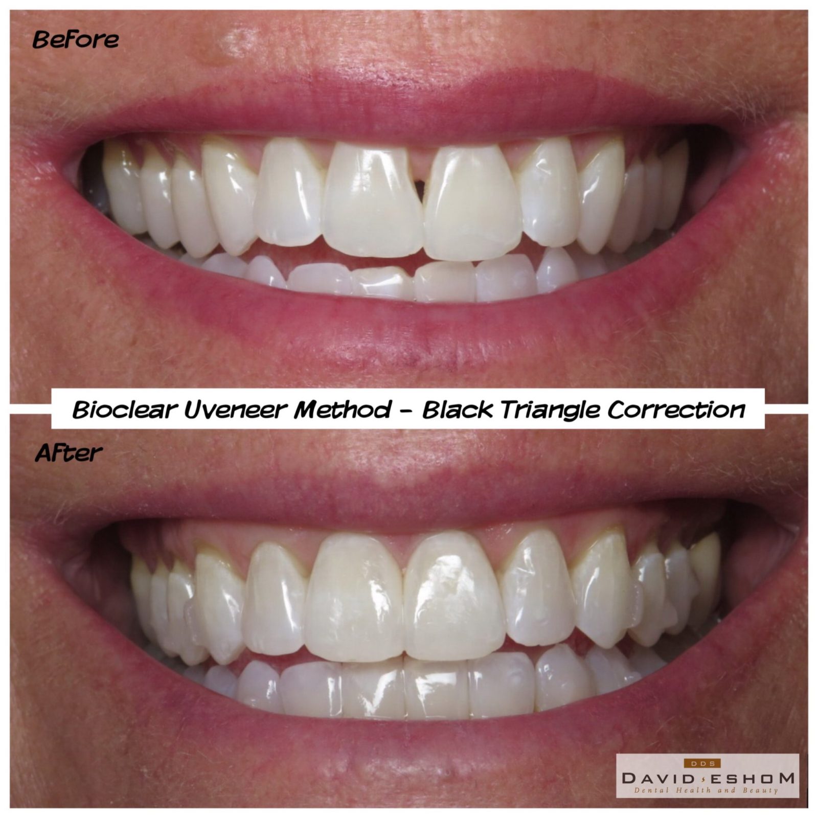 Bioclear Uveneer Black Triangle Correction David Eshom DDS, Dental