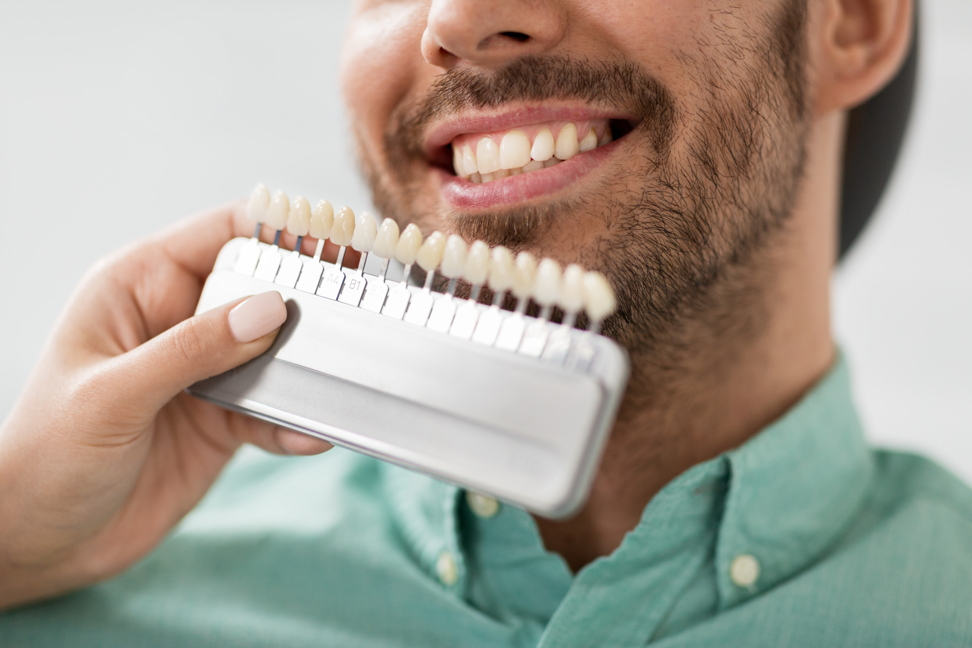 7 Important Things You Should Know Before Getting Veneers