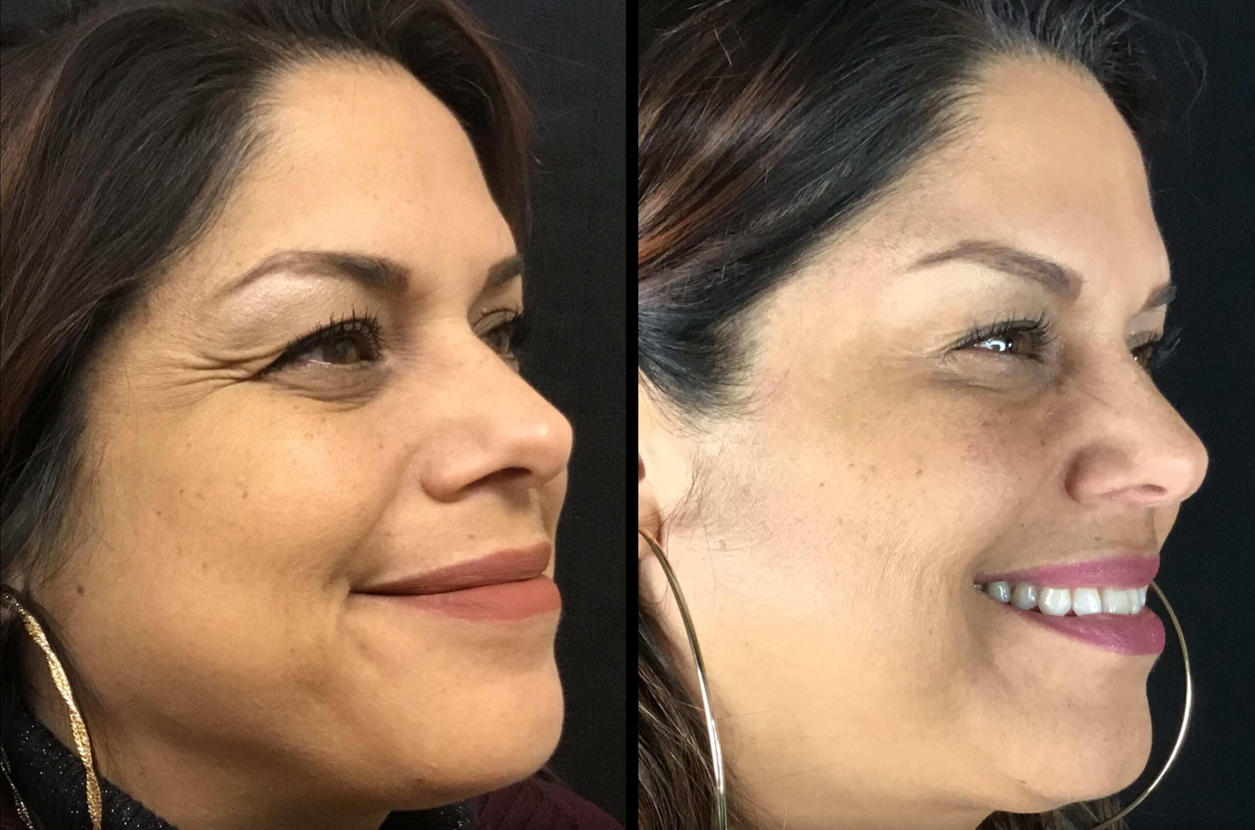 Breast Enhancement San Antonio Breast Lift Fat Transfer