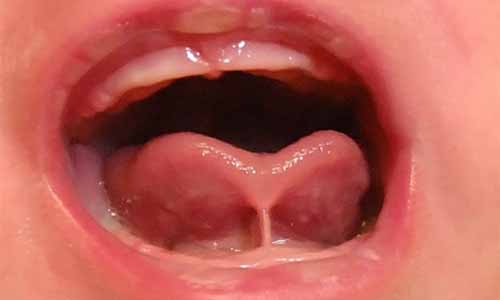What is Posterior Tongue Tie and How to Know if Your Child Has it