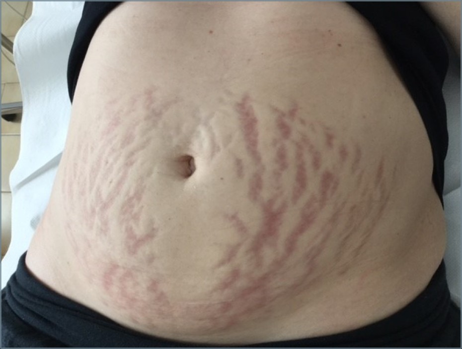 Stretch marks laser treatment Eufoton
