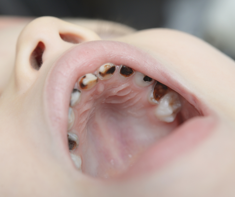 What Do You Do for a Baby with Cavities? Angela Evanson, DDS in