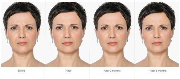Botox Injection Cost in USA 2020