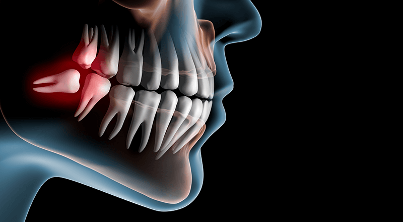 Wisdom Teeth Removal Cost Melbourne Wisdom Tooth Removal