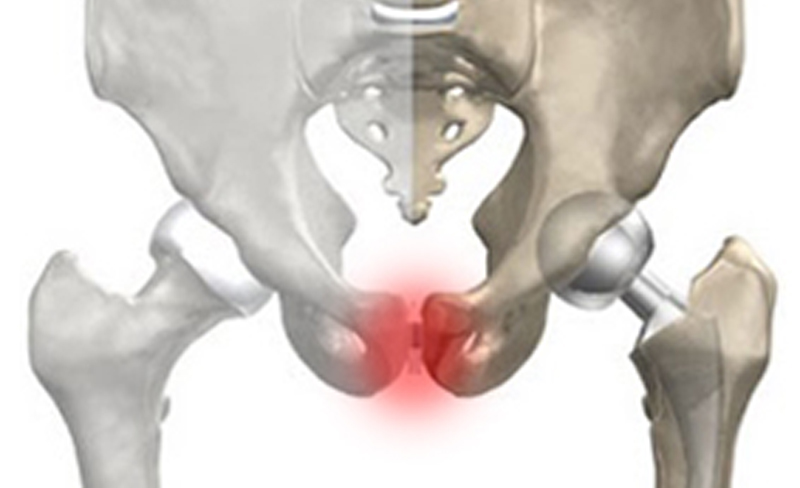Saiba tudo sobre Pubalgia FISIOTERAPIA DESPORTIVA