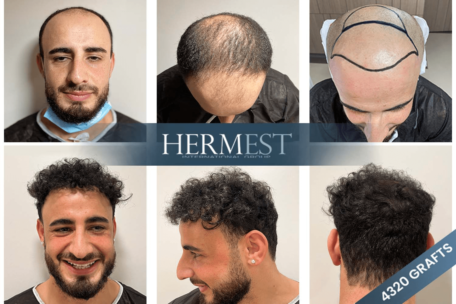 Find the Best Hair Transplant Clinic in Turkey