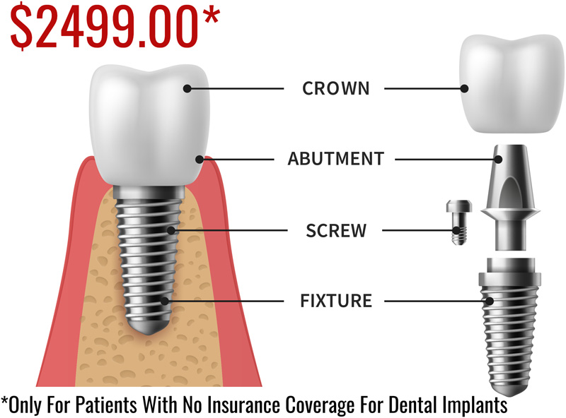 Dental Implants in Coraopolis, PA Dentist 15108