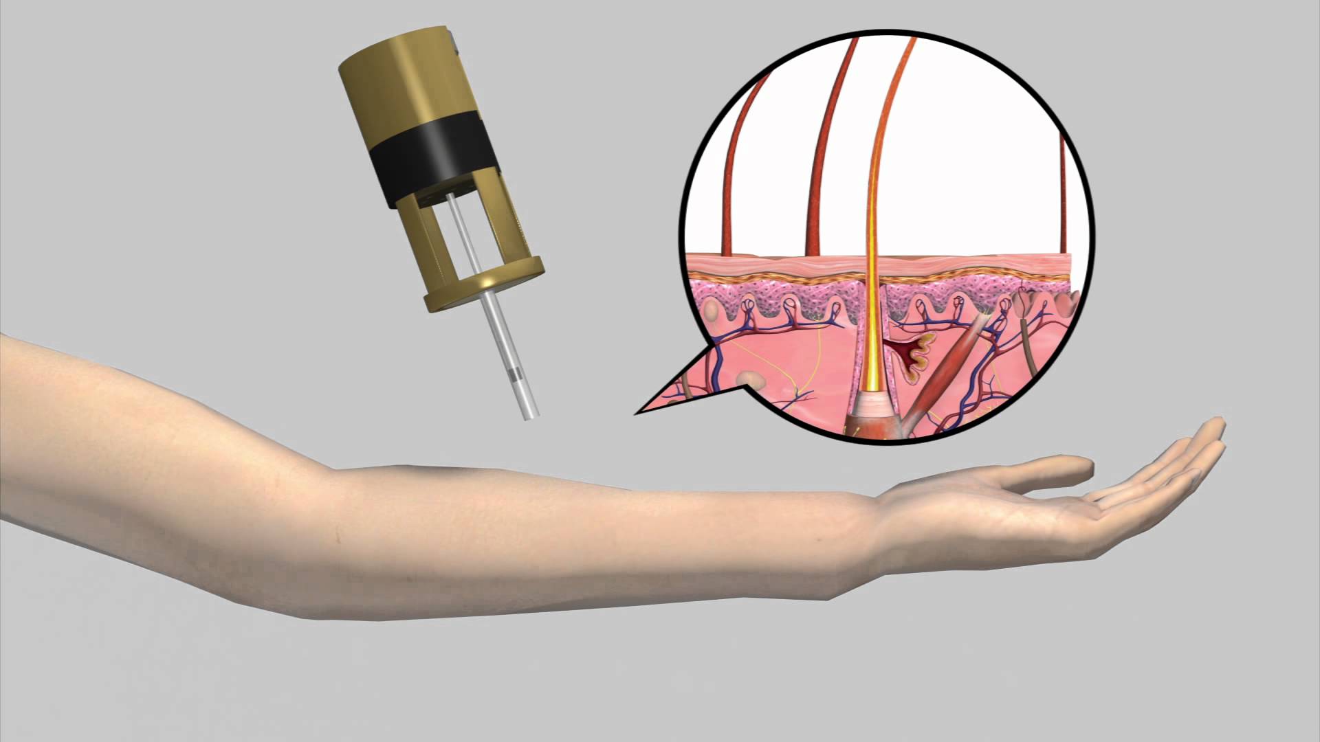 NeedleFree Injections For ED Do the Devices Work? ExcelMale