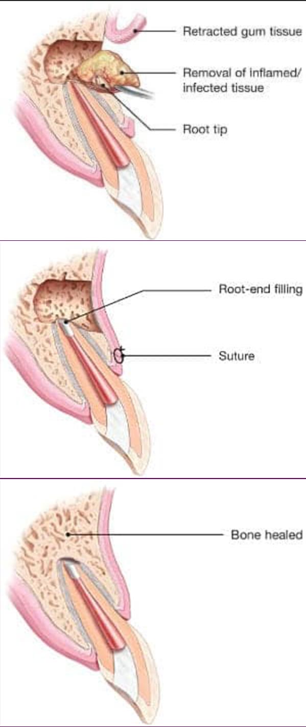 Endodontic Microsurgery in Clinton & Waldrof, MD, MD Endodontic