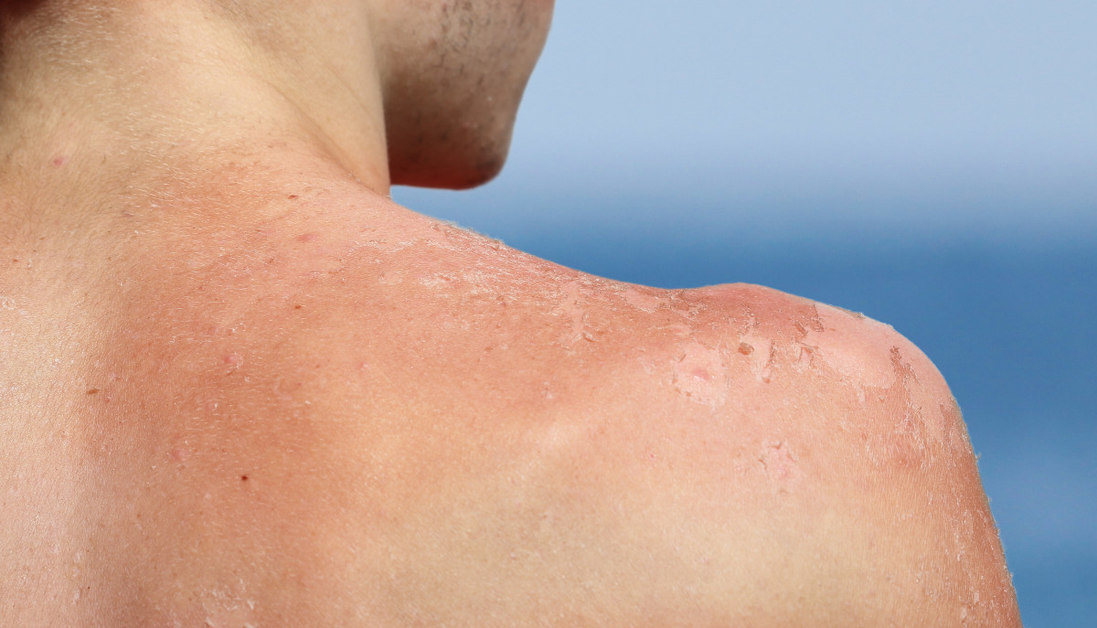 Hilfe für Ihre Haut Tipps gegen akuten Sonnenbrand experto.de