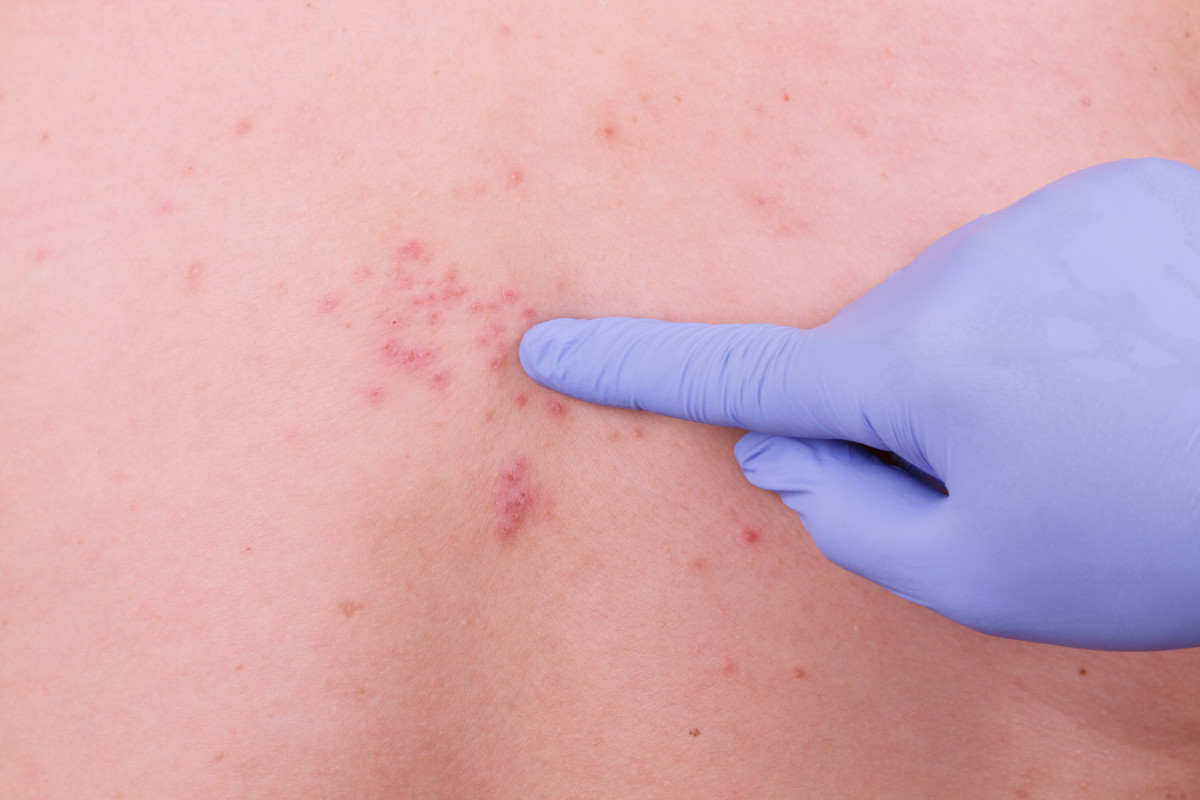 Ist gürtelrose ansteckend für schwangere paleotropical.