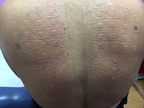Patch Testing for Chemical Allergies ExpressCare Guam Clinic