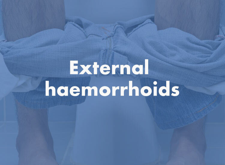 External Haemorrhoids Types of Haemorrhoids eXroid