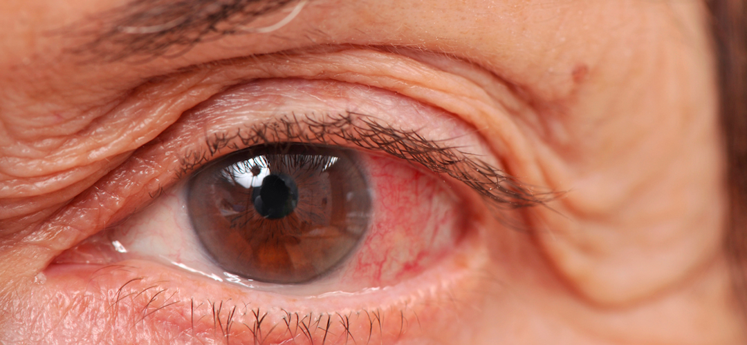 Glaukoma Klinika Uzllova