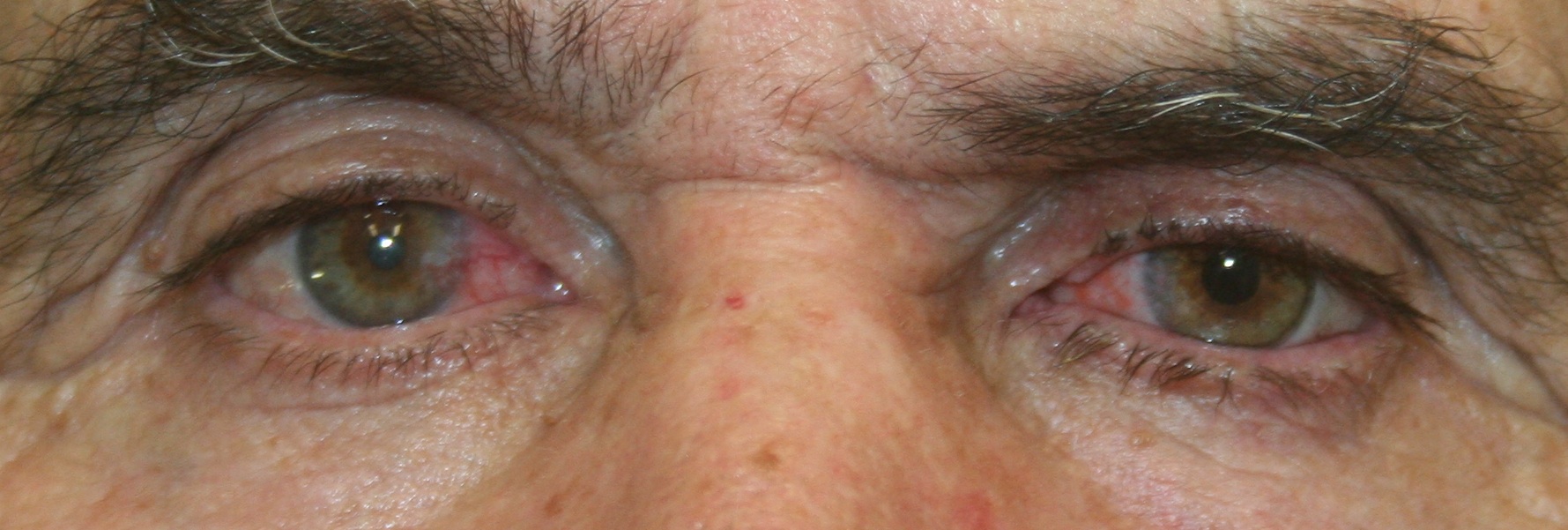 Prosthetic Examples EYEART Laboratories
