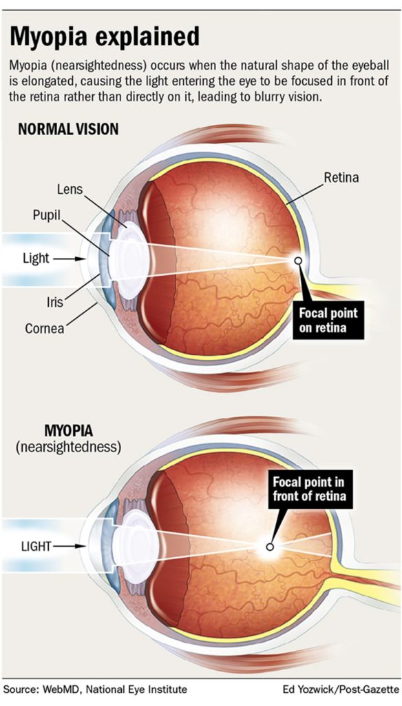 Nearsightedness in children Eyecare Associates of Lee’s Summit