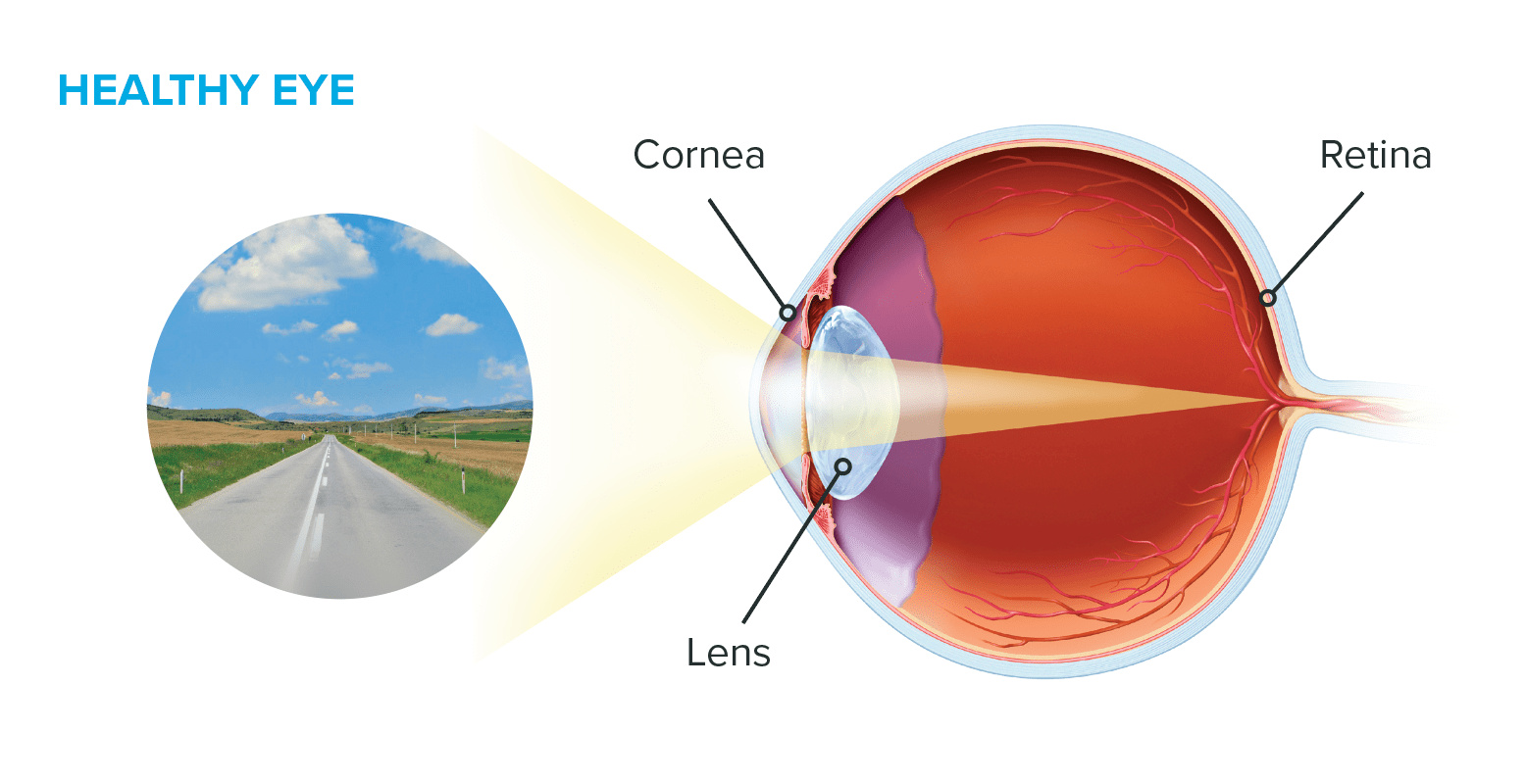 Cataract Surgery Athol Cataract Surgery Greenfield Eye Center
